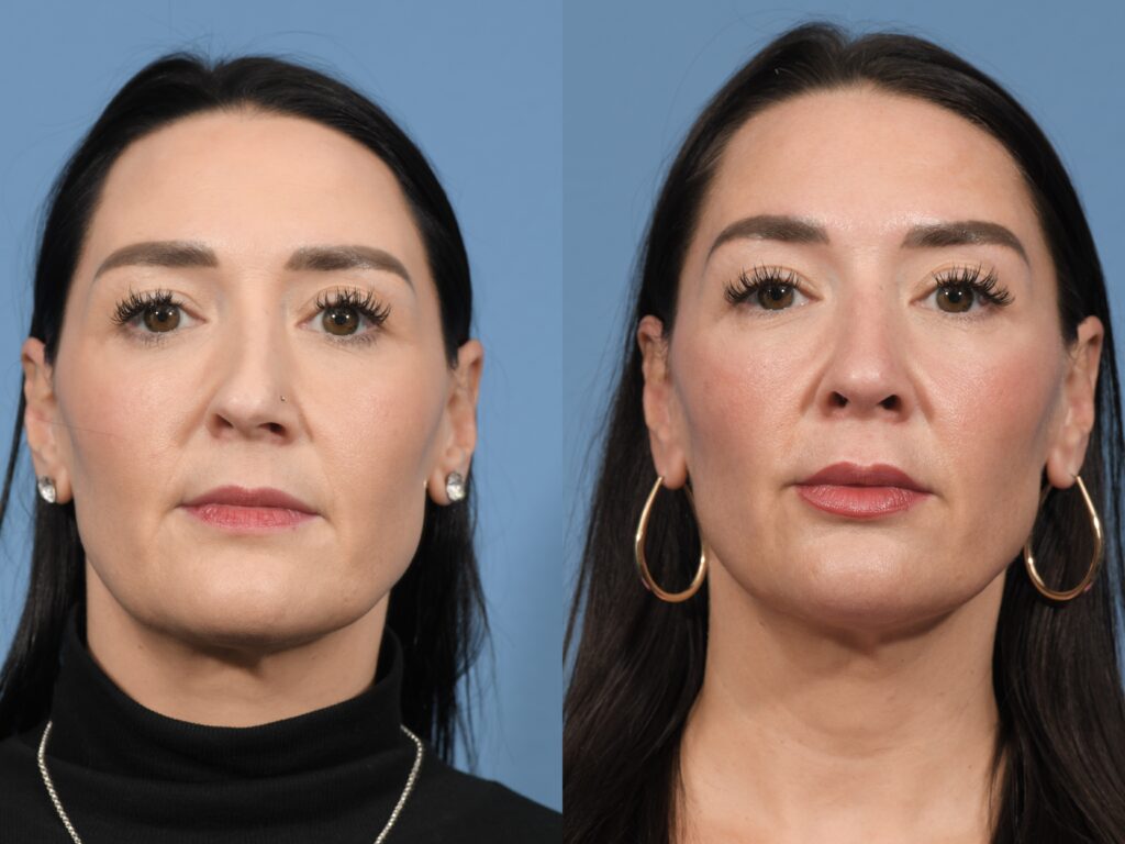 Rhinoplasty Before & After #31 before and after