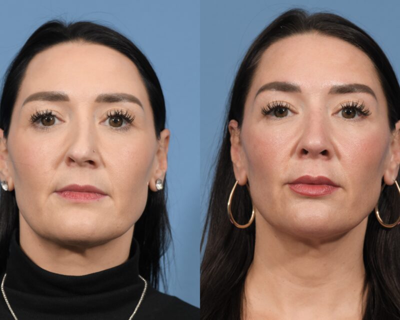 Rhinoplasty Before & After #31