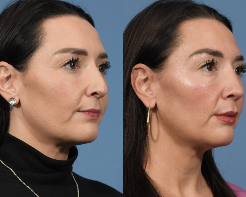 Rhinoplasty Before & After #31 image 2