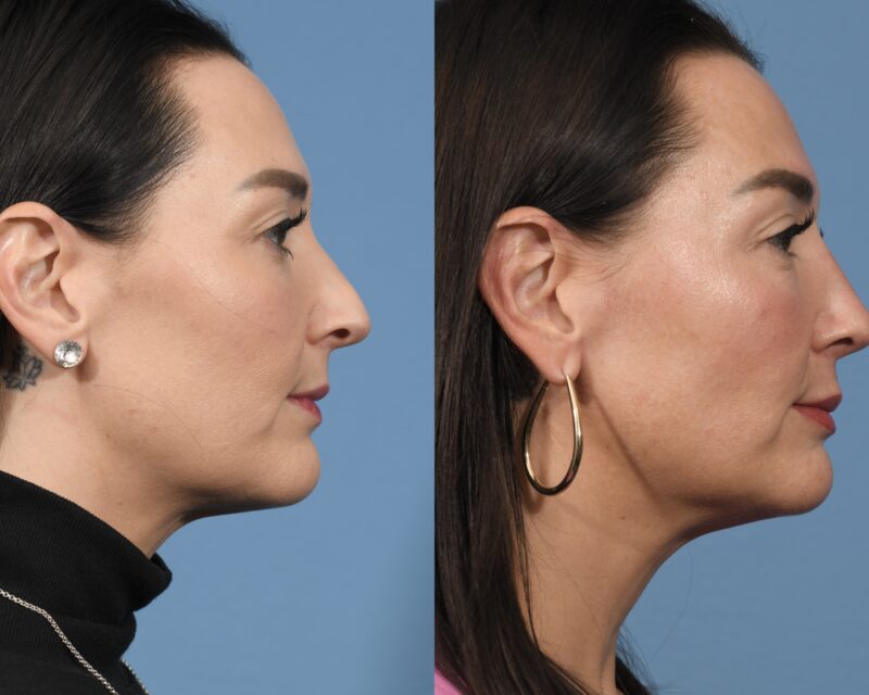 Rhinoplasty Before & After #31 image 3