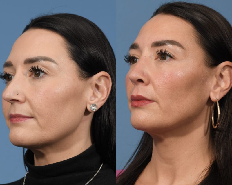 Rhinoplasty Before & After #31 image 4