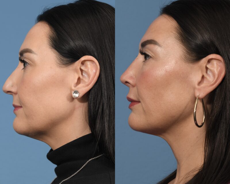 Rhinoplasty Before & After #31 image 5