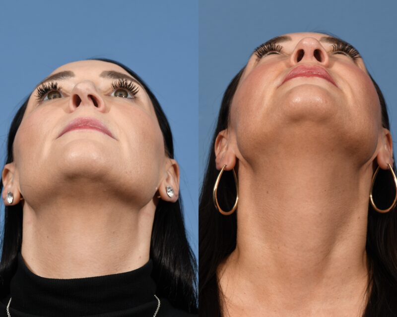 Rhinoplasty Before & After #31 image 6