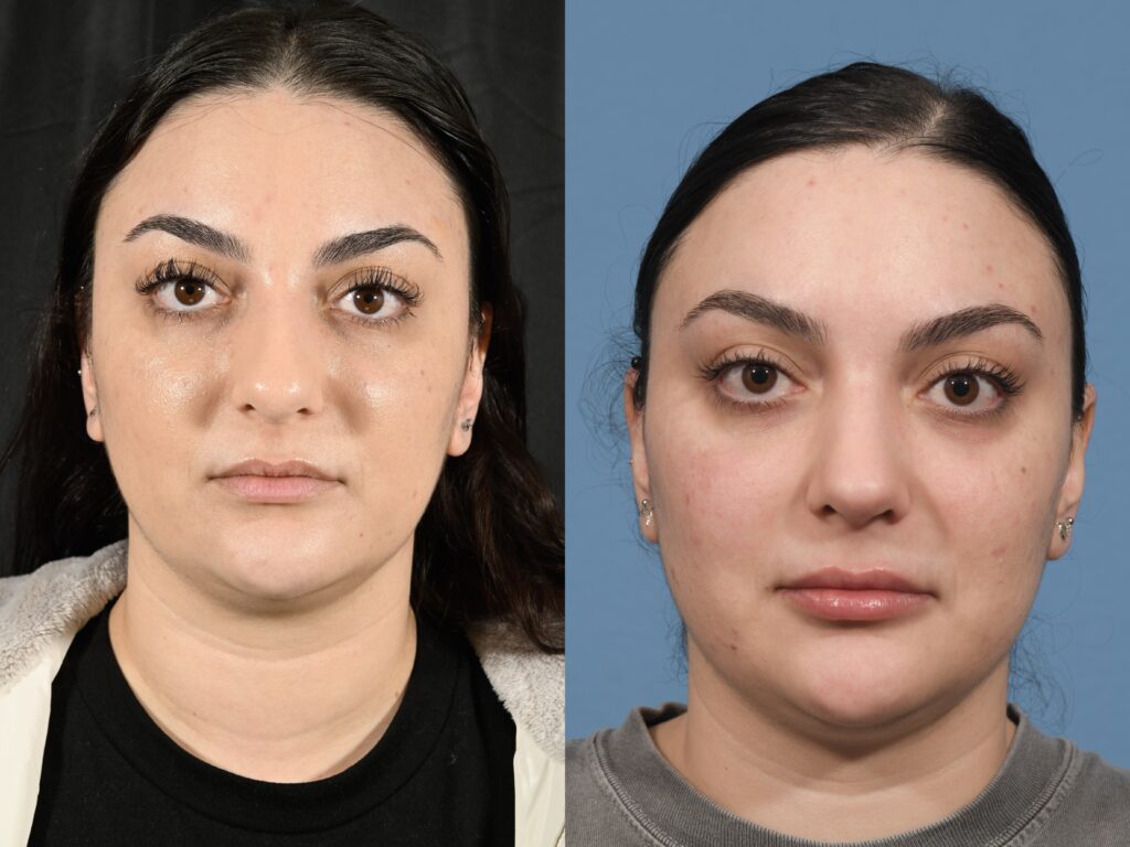 Rhinoplasty Before & After #32 before and after