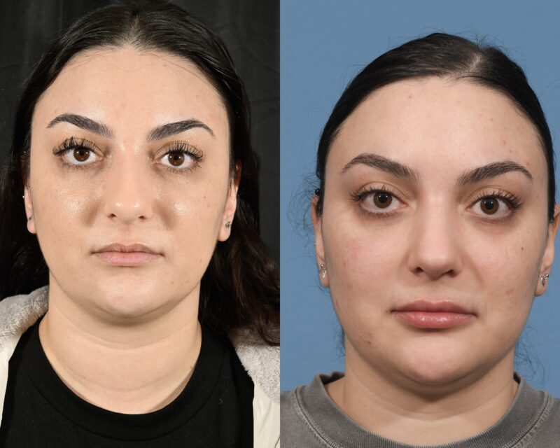 Rhinoplasty Before & After #32