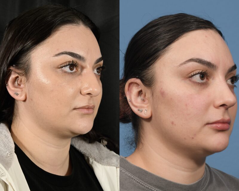 Rhinoplasty Before & After #32 image 2