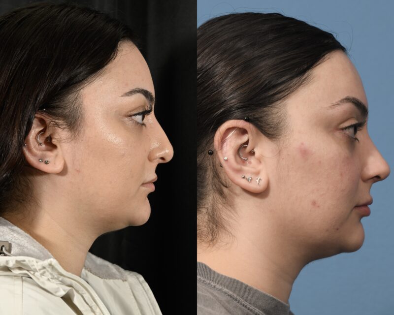 Rhinoplasty Before & After #32 image 3