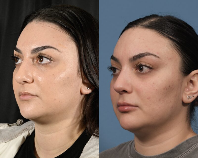 Rhinoplasty Before & After #32 image 4