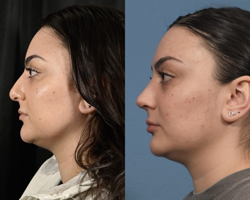 Rhinoplasty Before & After #32 image 5