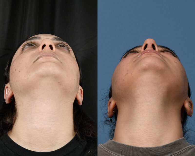 Rhinoplasty Before & After #32 image 6