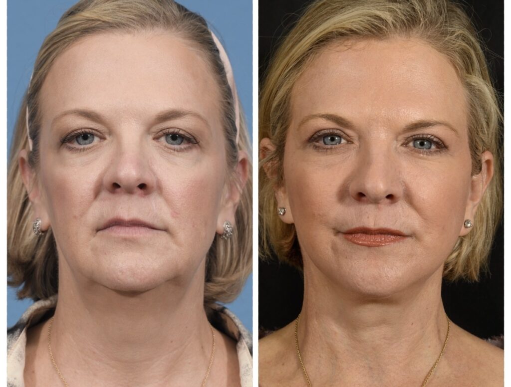 Facelift Before & After #23 before and after