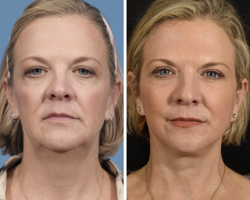 Neck Lift before and after