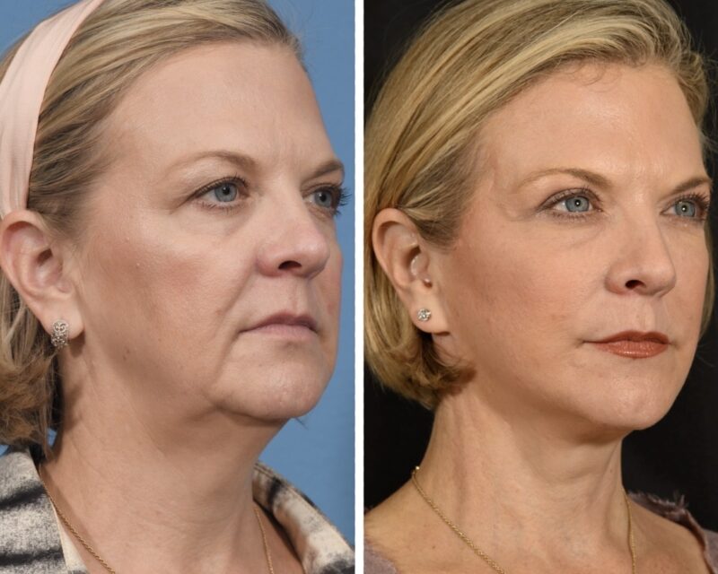Facelift Before & After #23 image 2