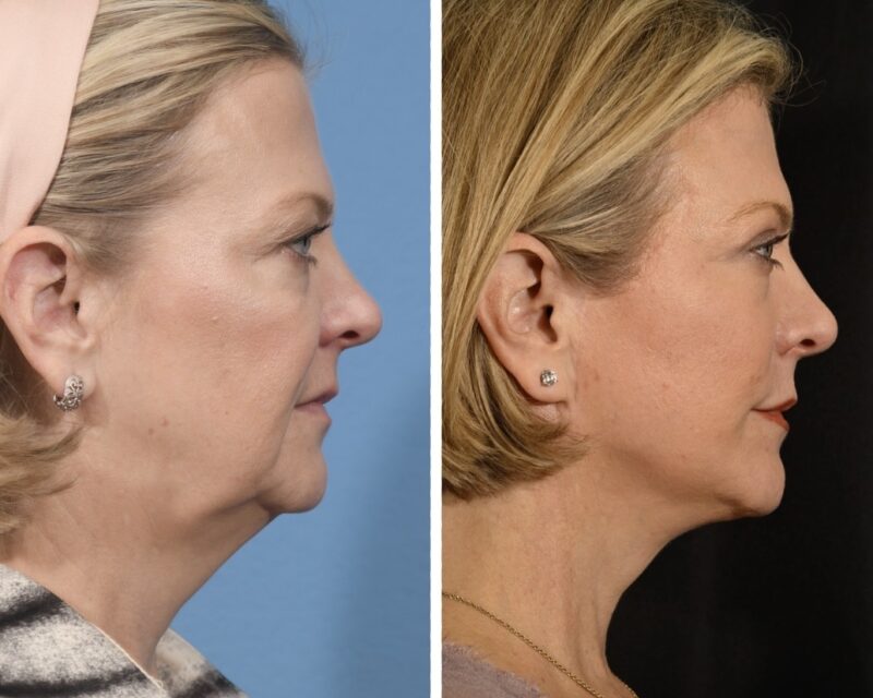 Facelift Before & After #23 image 3