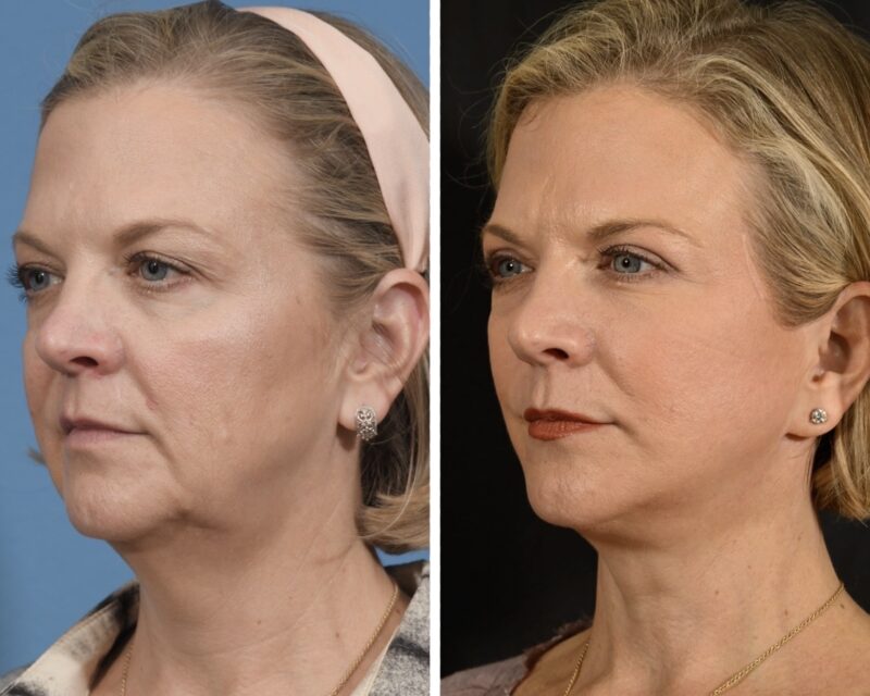 Facelift Before & After #23 image 4