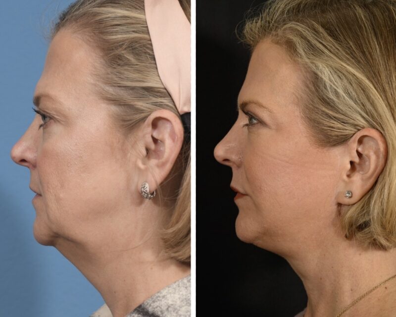 Facelift Before & After #23 image 5