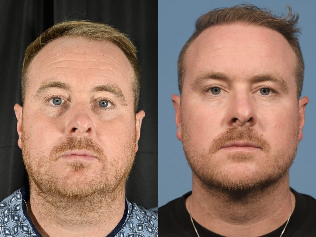 Hair Transplant Before & After #12 before and after