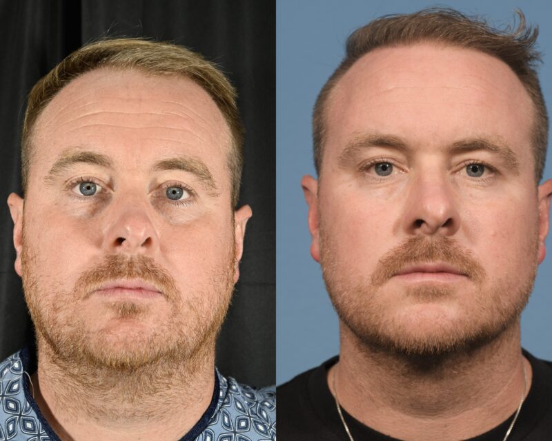 Hair Transplant Before & After #12 image 1