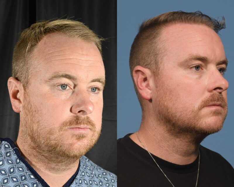 Hair Transplant Before & After #12 image 2