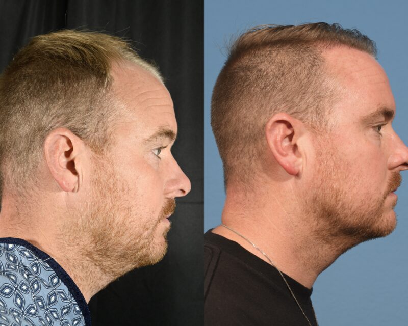 Hair Transplant Before & After #12