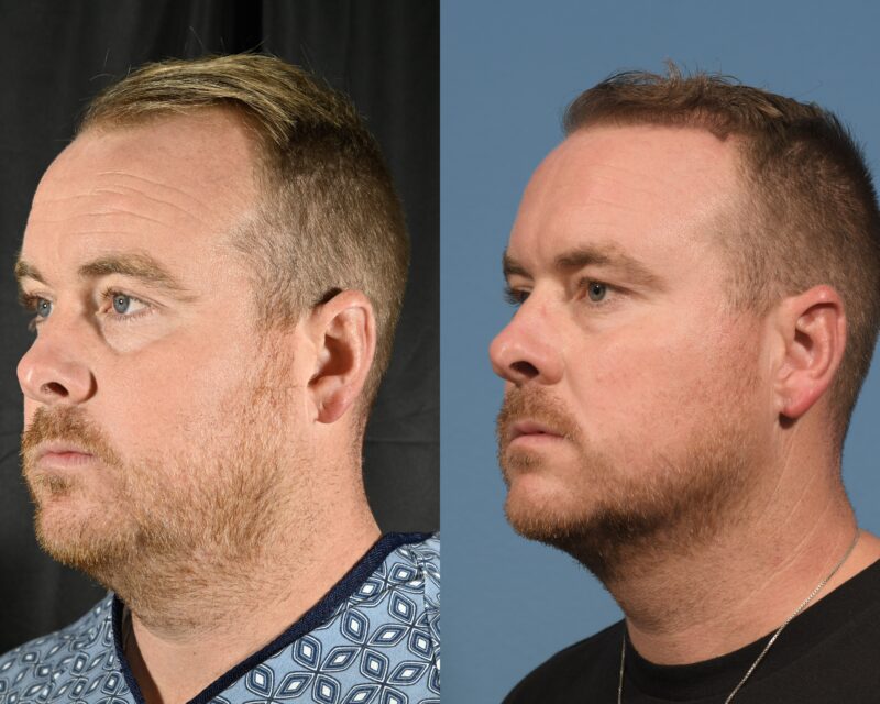 Hair Transplant Before & After #12 image 4