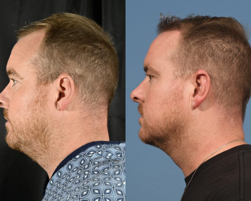 Hair Transplant Before & After #12 image 5