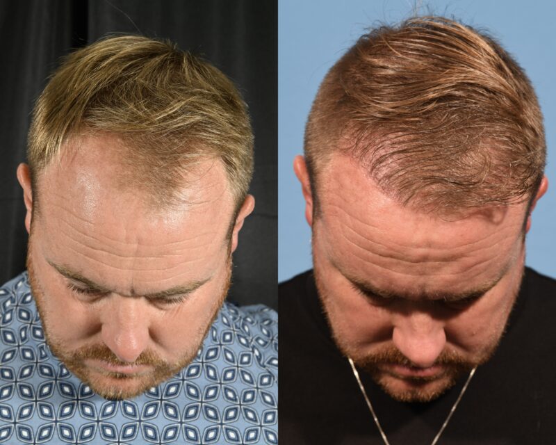 Hair Transplant Before & After #12 image 6