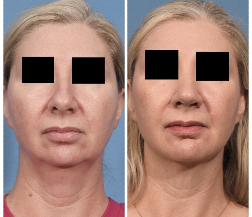 Rhinoplasty & Chin Before & After #2 before and after