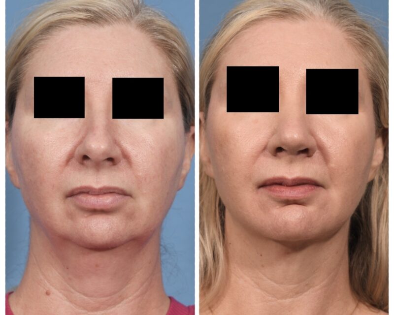 Rhinoplasty & Chin Before & After #2
