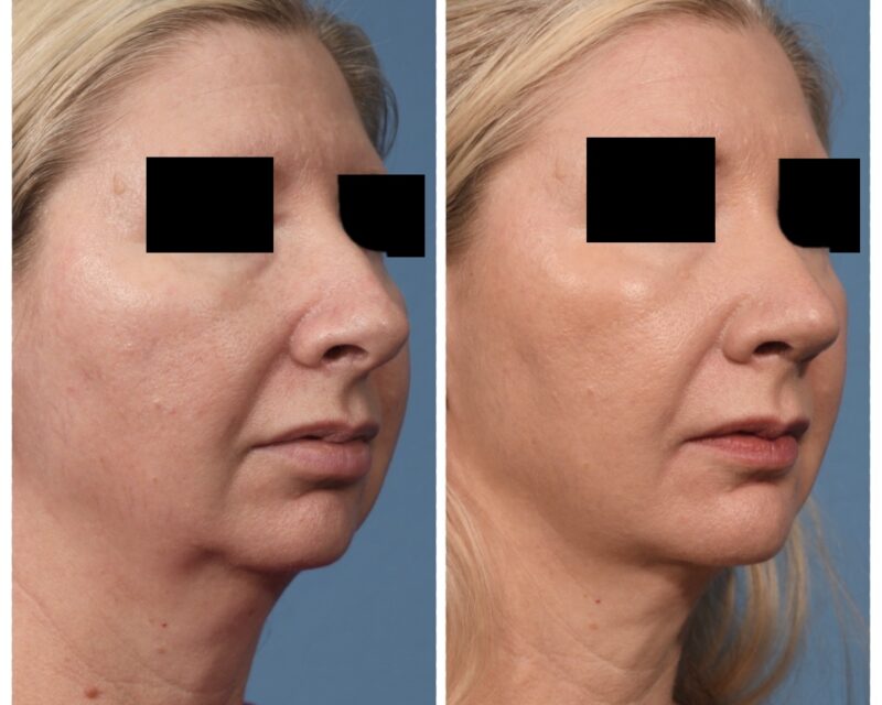 Rhinoplasty & Chin Before & After #2 image 2