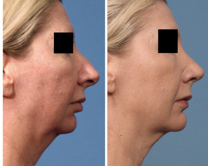 Rhinoplasty & Chin Before & After #2 image 3