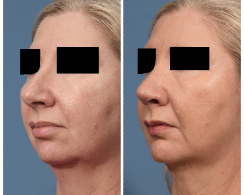 Rhinoplasty & Chin Before & After #2 image 4