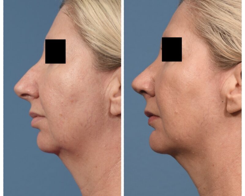Rhinoplasty & Chin Before & After #2 image 5